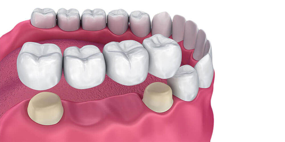 Dental Bridges Lloydminster