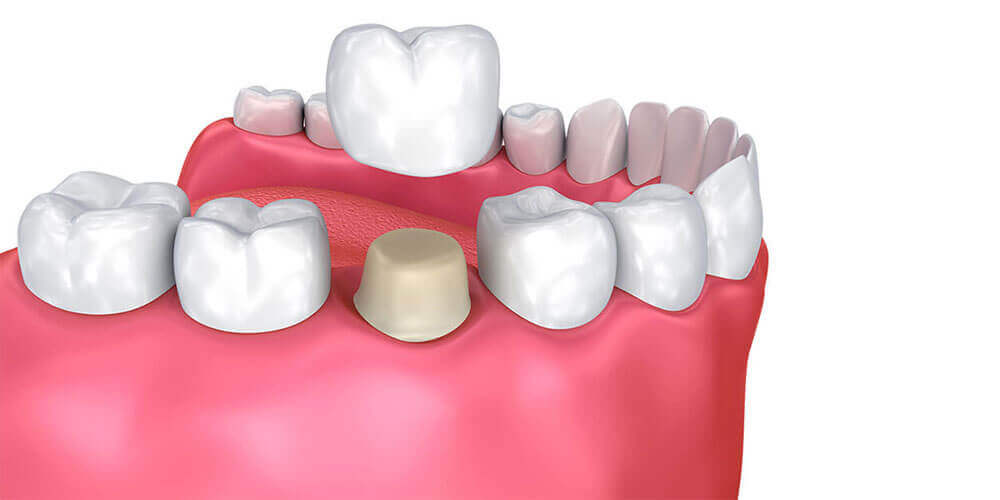 Dental Crowns Lloydminster