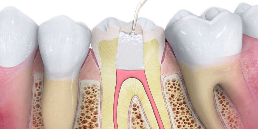 Root Canal Treatment Lloydminster